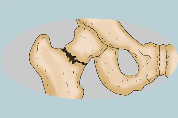 骨折和骨裂有什么区别,骨折和骨裂哪个比较好治疗