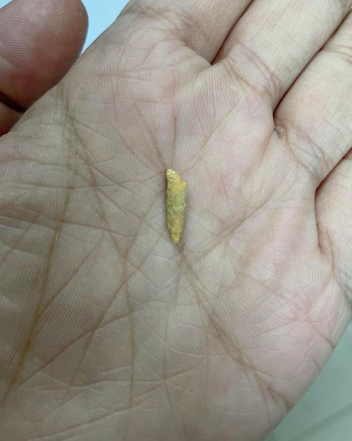 从舌头下面拔出一颗石头,舌头下面掉了一个石头出来了