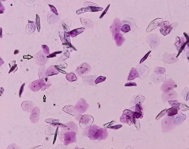 上皮细胞3+什么意思,上皮细胞阳性