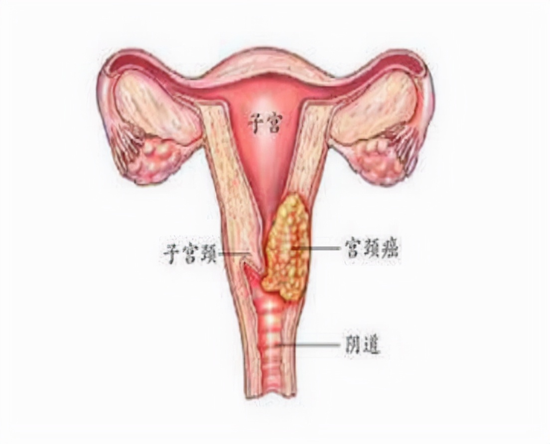 女性腿疼是宫颈癌的早期预兆吗,女性双腿疼痛查出宫颈癌