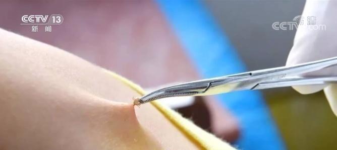 蜱虫叮咬患莱姆病,如何防治蜱虫叮咬