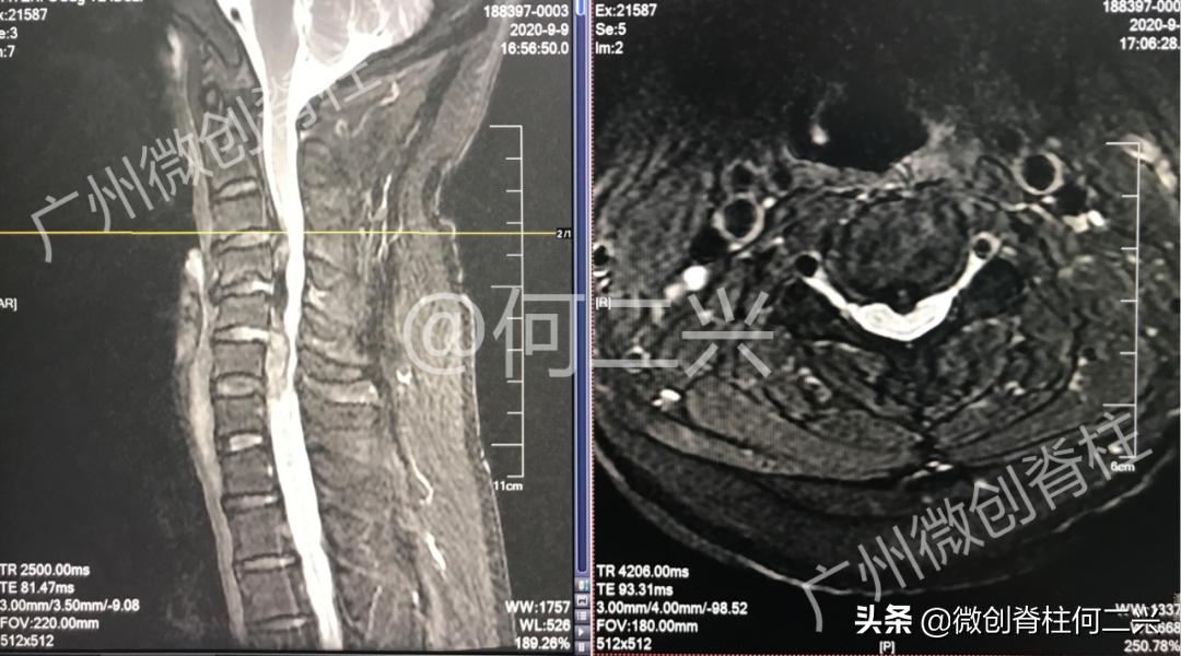 脊柱外科微创手术全过程,胸椎后纵韧带骨化症微创手术