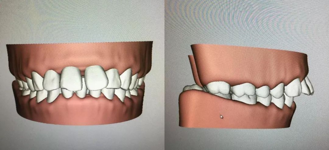 龅牙矫正前后对比照片,龅牙修复效果图