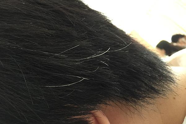 年轻却一头白发,年纪轻轻却长了白发