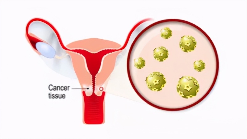 切除子宫后意外发现了宫颈癌,切掉子宫宫颈癌能活30年吗