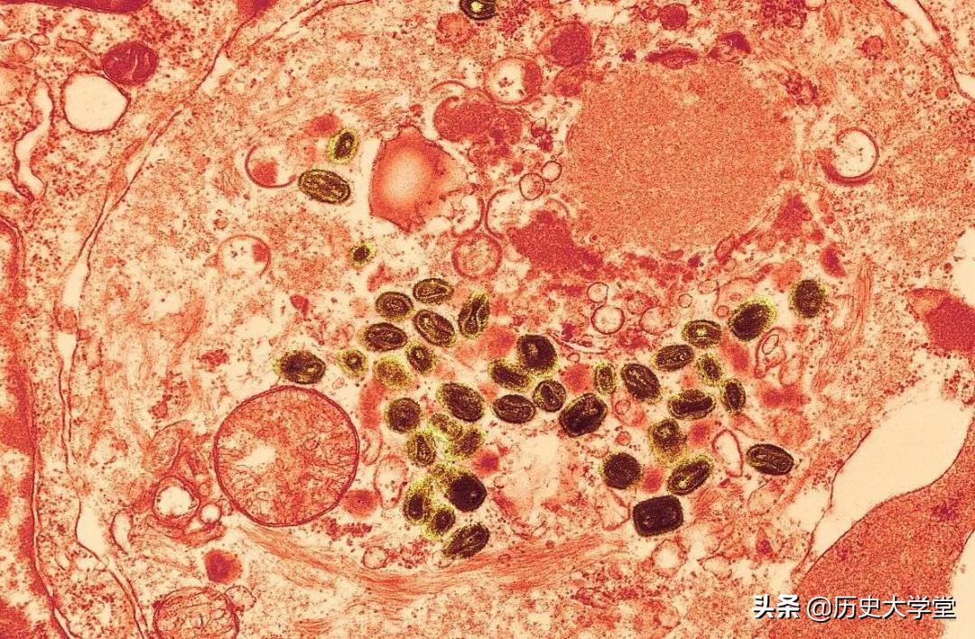 人类消灭天花是个奇迹,人类为什么可以消灭天花