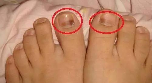 跑步后脚趾甲充血变黑怎么办,跑步为什么有黑指甲