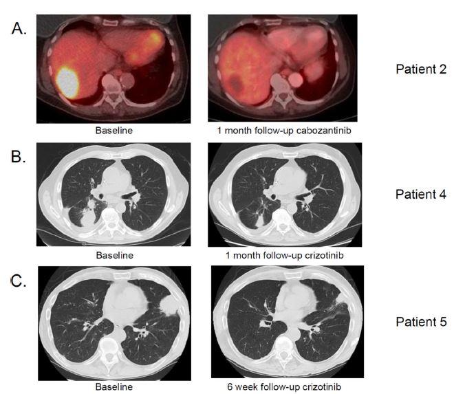 多年长跑，万众期待：这款抗癌好药capmatinib上市了，有效率68%