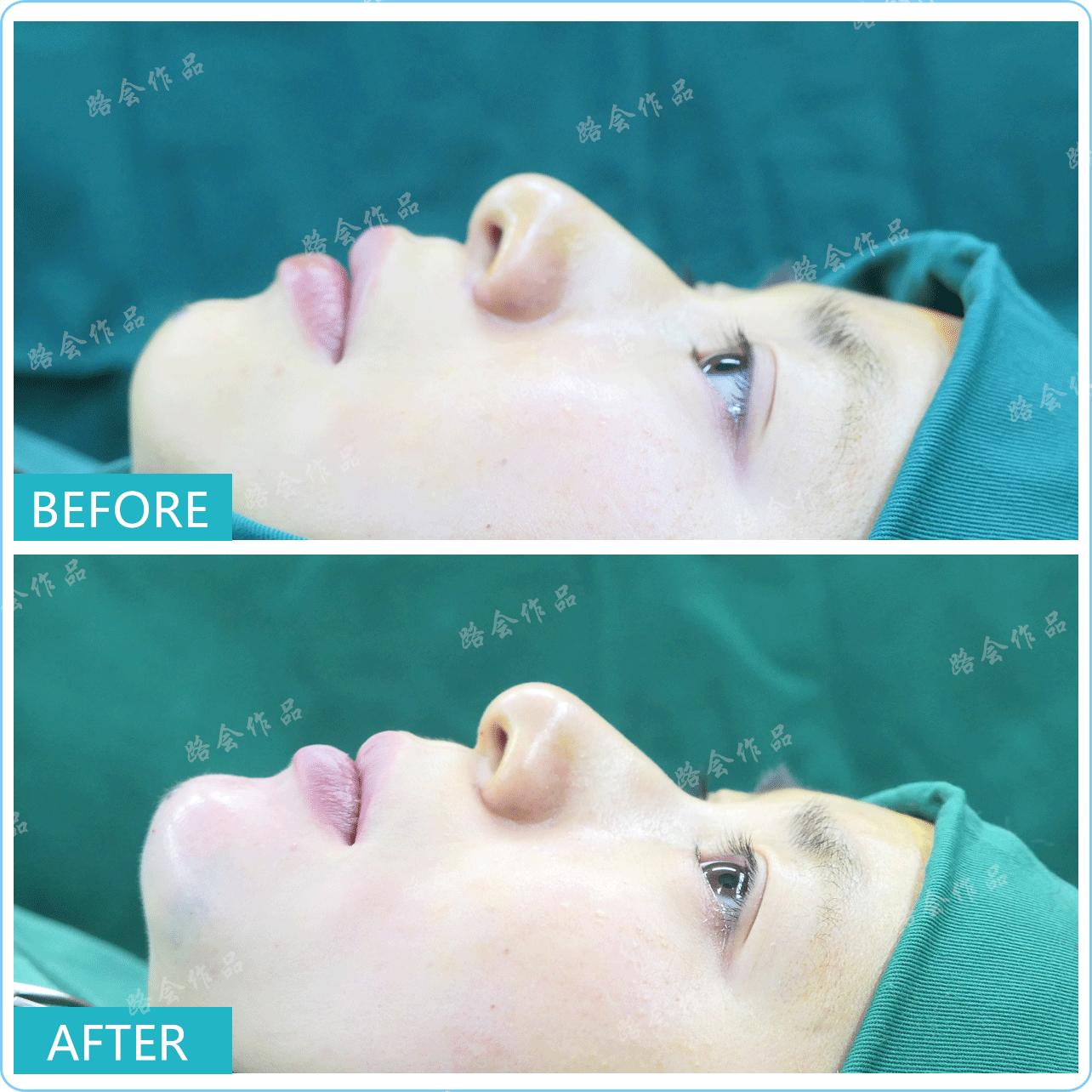 隆下巴硅胶和膨体哪个好,膨体隆下巴和硅胶隆下巴区别