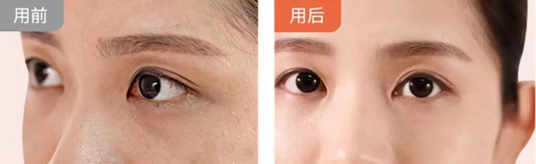 李湘直播间推荐祛痘,李湘推荐美容仪小v脸