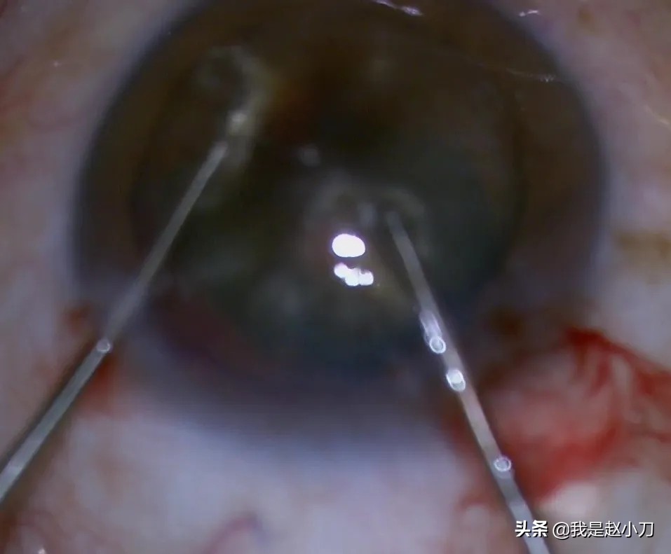 虹膜炎瞳孔已经粘连了怎么办,虹膜炎瞳孔粘连打针需要几次