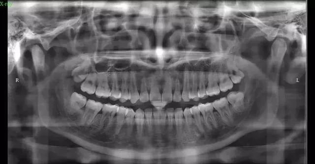 一分钟带你看牙齿矫正的全过程,最常见的牙齿矫正问题速度收藏