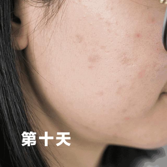 浠欎汉鎺岀棙鑲屼慨鎶よ啅,鐪嬪畬鐥樼棙浠ュ悗鎰熻鏇翠弗閲嶄簡