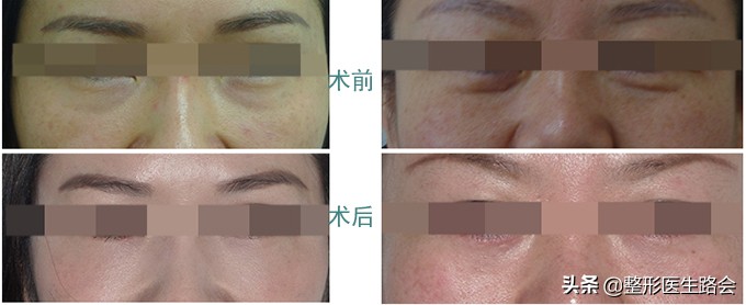 祛眼袋导致外翻怎么办,祛眼袋手术后有细纹会慢慢恢复吗