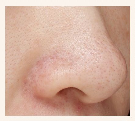 去黑头不踩坑,去黑头正确操作