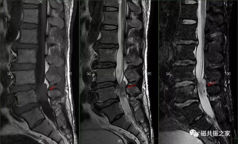 腰椎有哪些病变,腰椎病变有几种