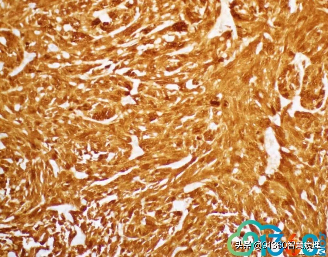 宫颈腺癌silvaa型用化疗吗,宫颈腺癌silvab型需要放疗几次