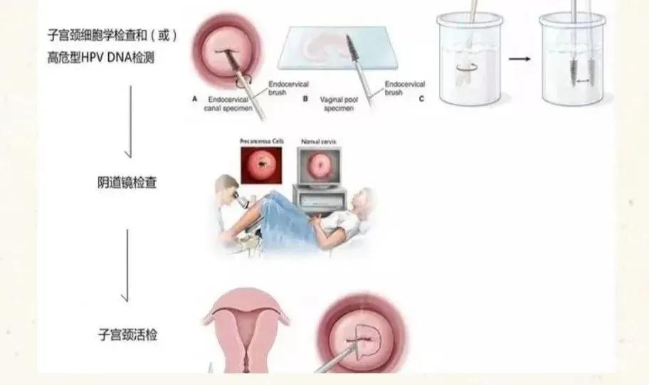 宫颈癌前病变科普视频,宫颈癌癌前病变离宫颈癌还有多远