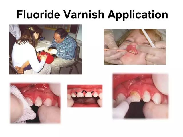 为什么牙齿会蛀牙儿童科普,儿童牙齿长白点是蛀牙吗