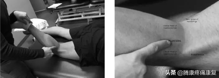 腓肠肌撕裂的治疗方法,腓肠肌网球腿