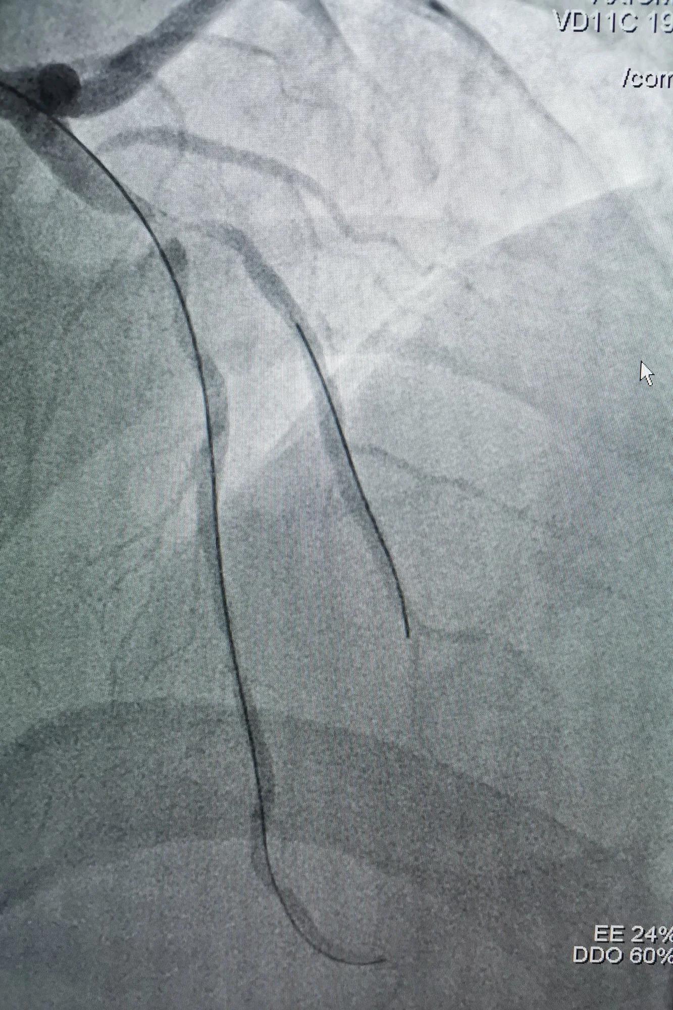 atp术式治疗冠脉分叉病变,冠脉分叉处堵塞能治吗