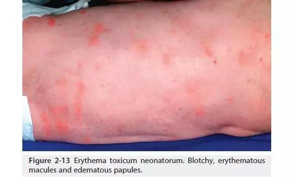 新生儿皮肤问题大全一览表,新生儿常见八大皮肤问题