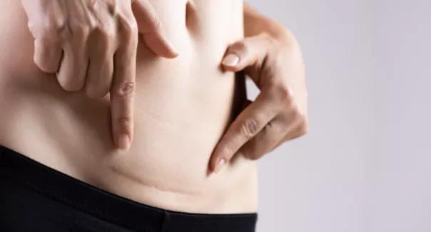 剖宫产刀口增生了涂什么药膏,剖腹产刀口增生期怎么护理