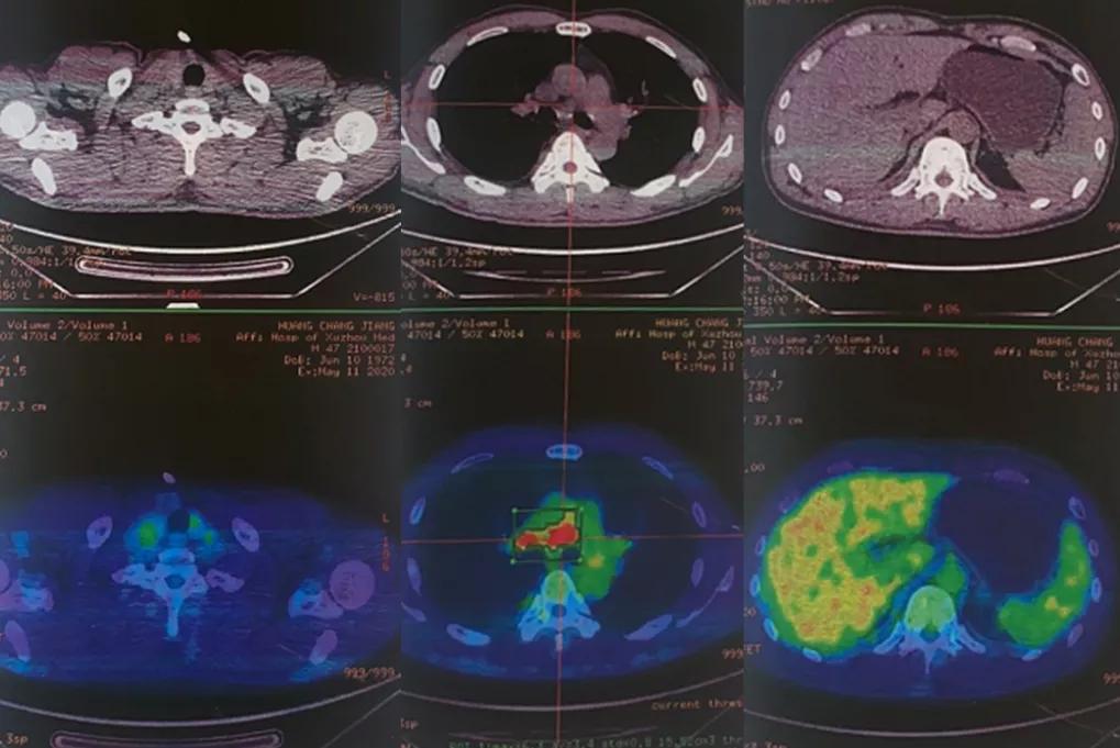 少量胸闷胸腔积液会引起什么,胸腔积液引起的胸闷憋喘