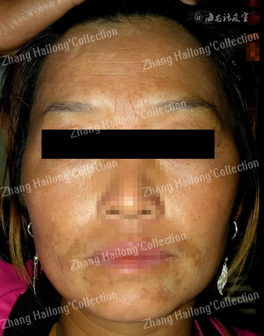 褐青斑怎么治疗最有效果,褐青斑有哪些治疗方法