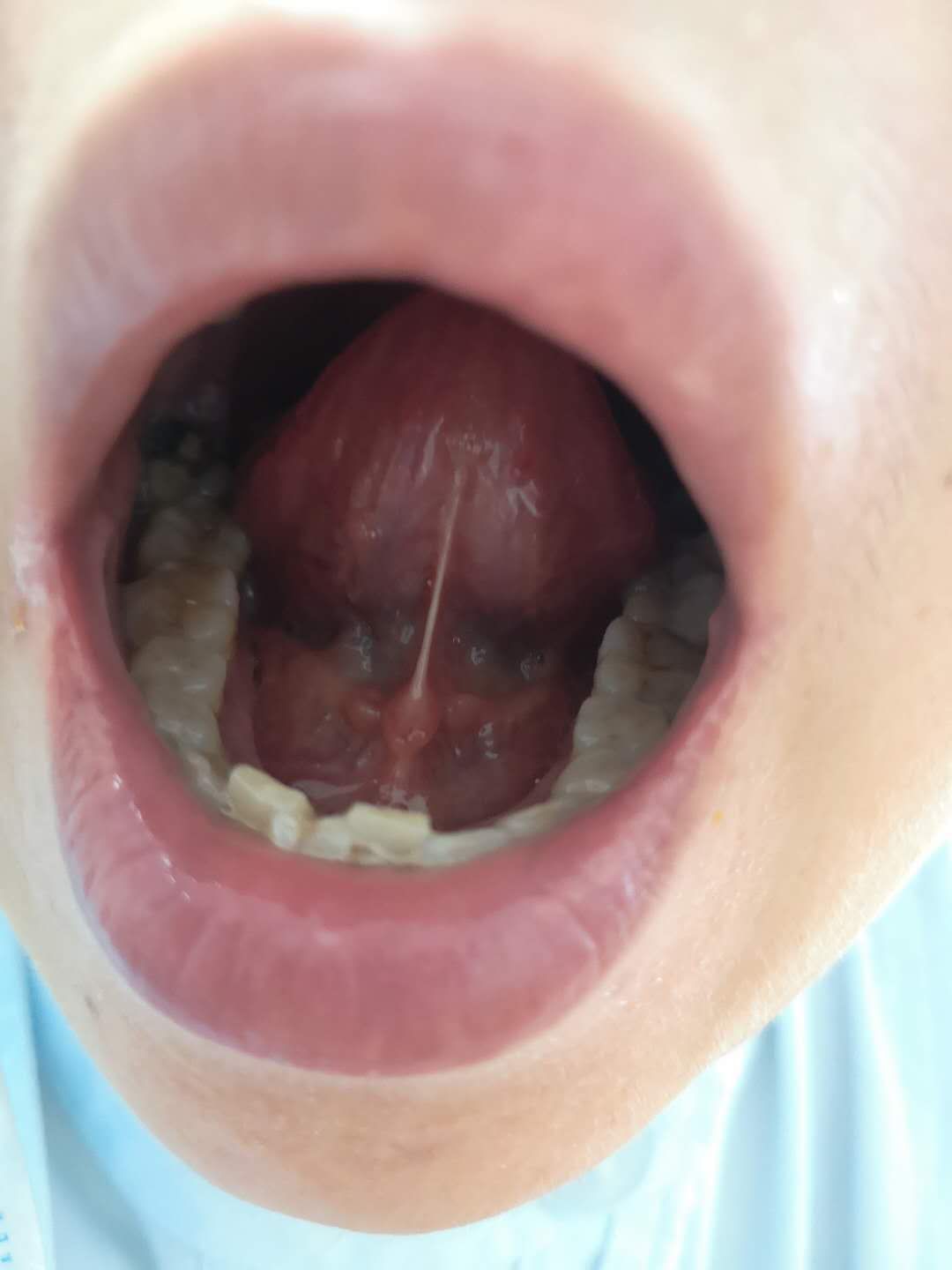 治疗耳石症的五种中成药,有没有治疗耳石症的西药