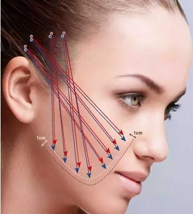 线雕痛吗脸部做线雕的亲身经历,线雕面部提升线多久吸收完