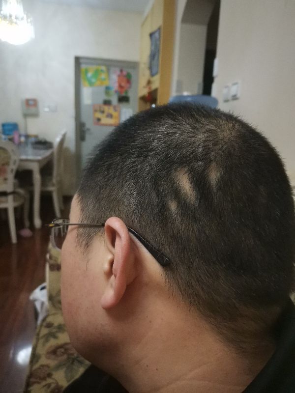 发现斑秃刚好又开始掉头发怎么办,突然发现斑秃怎么治疗