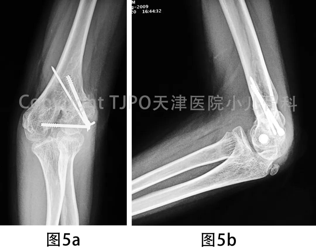 肱骨髁上骨折如何预防肘外翻畸形,肱骨髁上骨折外翻畸形原因