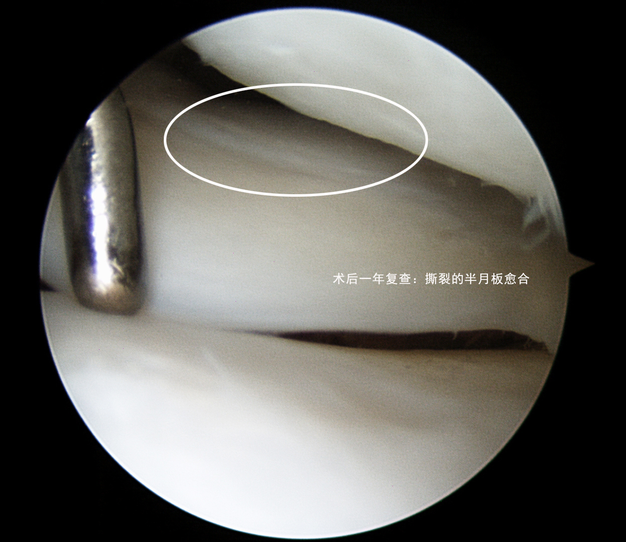 半月板撕裂手术后会有哪些症状,半月板撕裂时间长了可以做手术吗