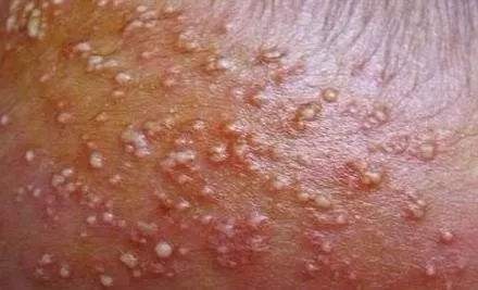 痱子粉和痱子粉的区别,痱子用药皂还是肥皂