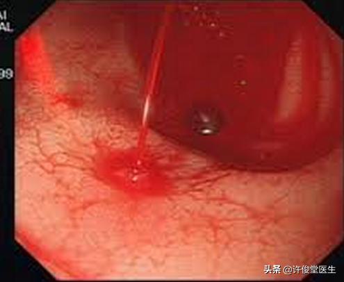 都在防治高血压，那低血压呢？