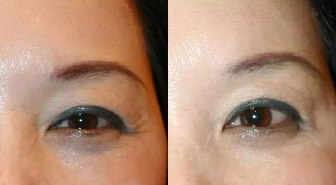 抗皱纹抗老小妙招,30岁后的面部抗老思路