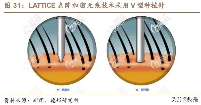 植发行业深度分析,2023年植发行业趋势