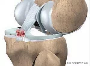 导致膝关节疼痛的原因有很多，防治方法有哪些？