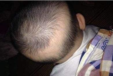 小孩得鸡胸和x型腿的原因,小孩鸡胸是怎么引起