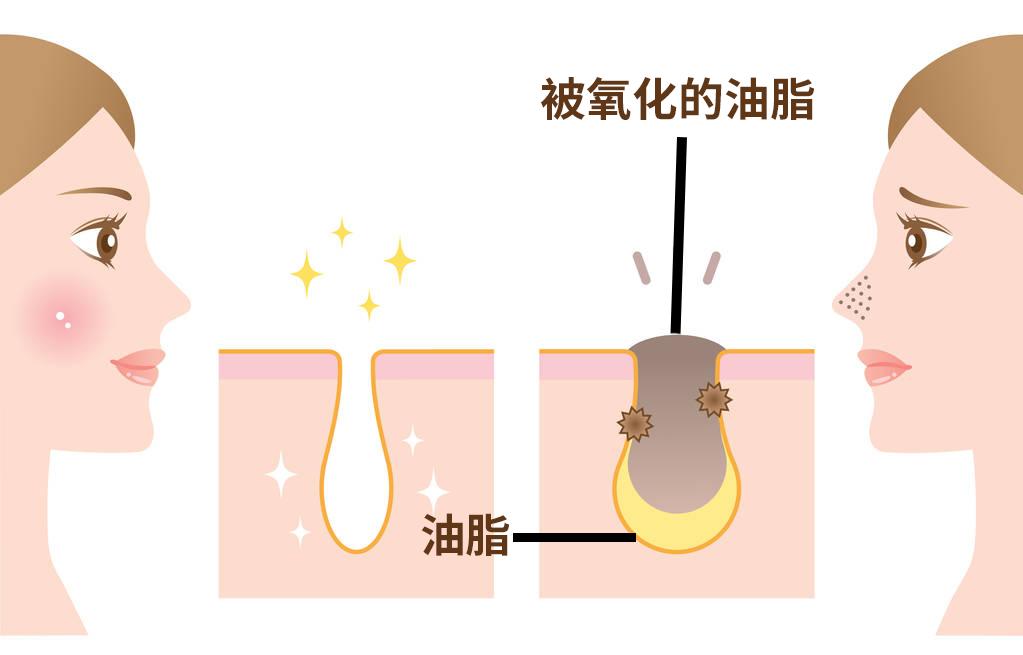 十滴水碘伏甲硝唑治黑头,十滴水加碘伏祛黑头用法