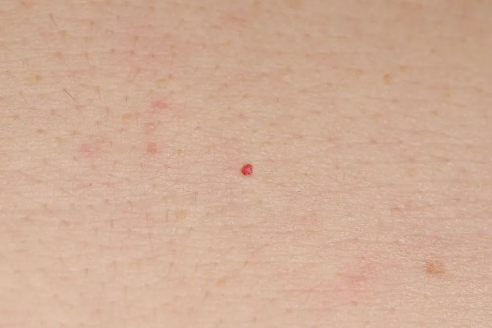 过敏身上突然长了小红点是啥原因,身上突然出现小红点不痛不痒图片