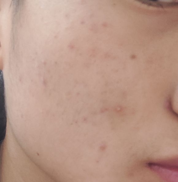 一化妆就闷痘长闭口怎么办,化妆造成的痘痘怎么快速好