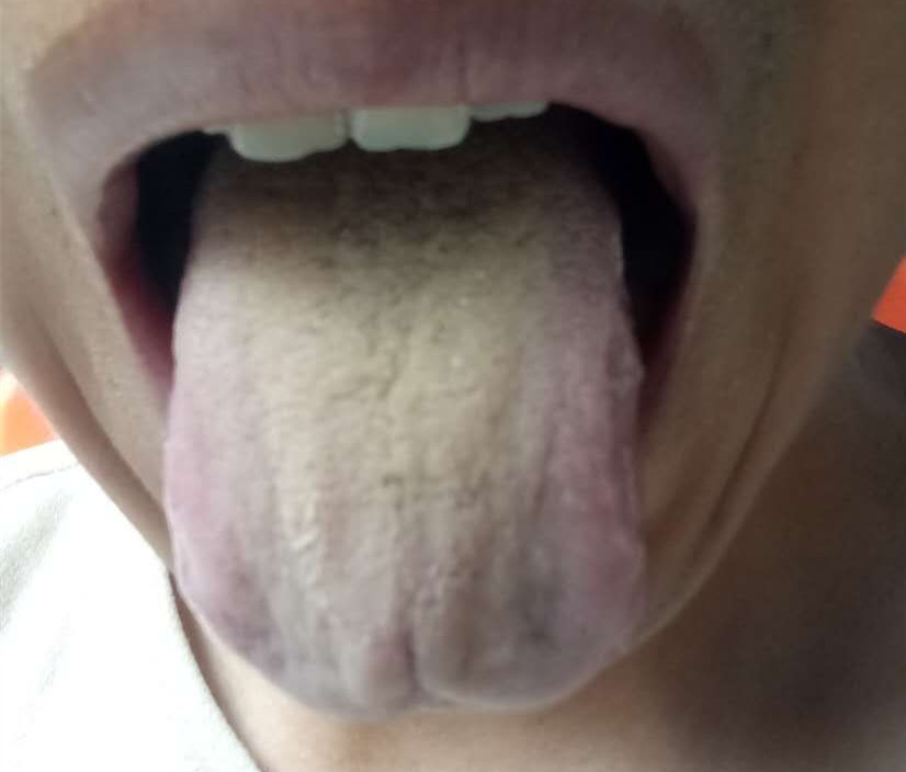 尿频尿急尿液有泡沫是肾病吗,湿气重小便会有什么症状