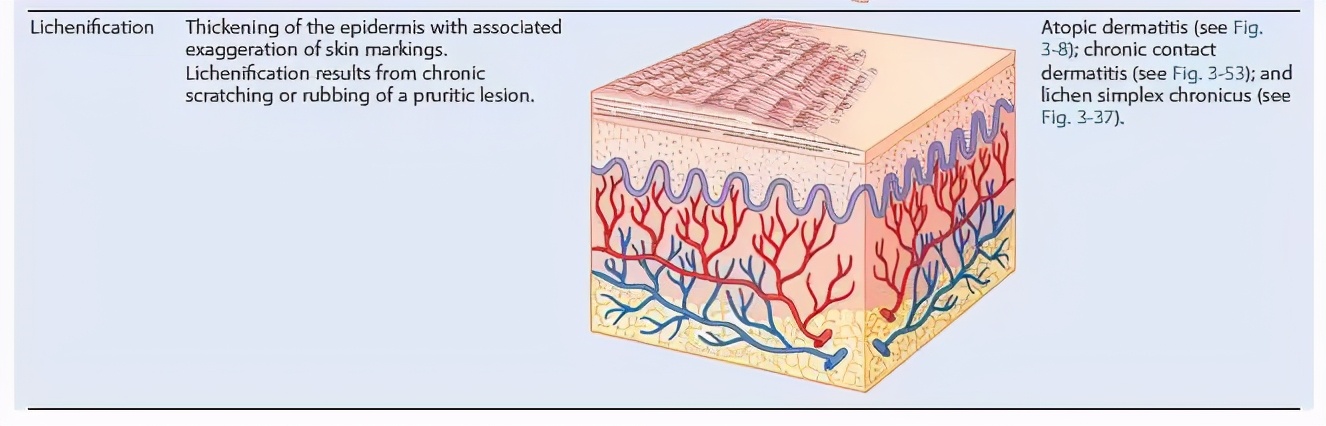 天一热手上就起一层小疙瘩还很痒,两只手上长密集的小疙瘩很痒很红
