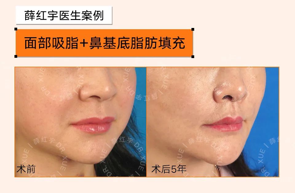 法令纹怎么改善脸部衰老,改善法令纹按摩手法视频