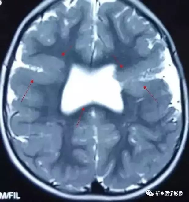 影像学脑室扩大,脑室显大怎么理解