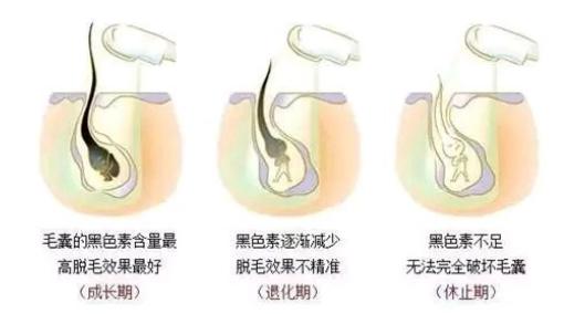 beautigo脱毛仪可以永久脱毛吗,脱毛仪beautigo刮过毛多久用