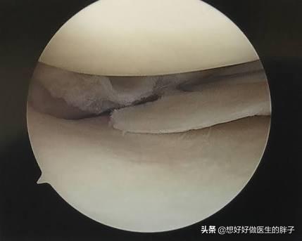 半月板撕裂手术后怎么自己做康复,半月板撕裂手术最佳自愈方法
