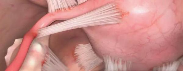 研究人员找到一种潜在治疗方法,有望解决让医生都发怵的术后粘连